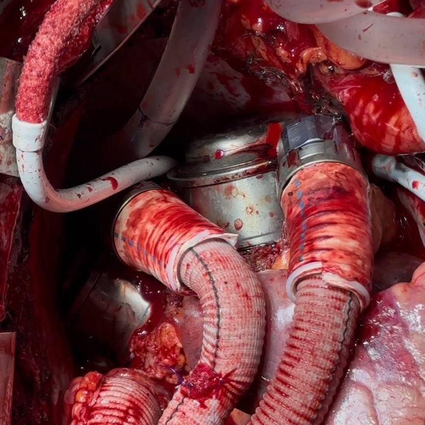 В СПб ГБУЗ «Городская Мариинская больница» поступил мужчина с терминальной стадией сердечной недостаточности. При поступлении фракция выброса его левого желудочка составляла всего 10%. У пациента ранее была диагностирована дилатационная кардиомиопатия смешанного генеза. У него также был целый комплекс опасных осложнений: рецидивирующая тромбоэмболия лёгочной артерии, хроническая тромбоэмболическая лёгочная гипертензия, инфаркт-пневмония.