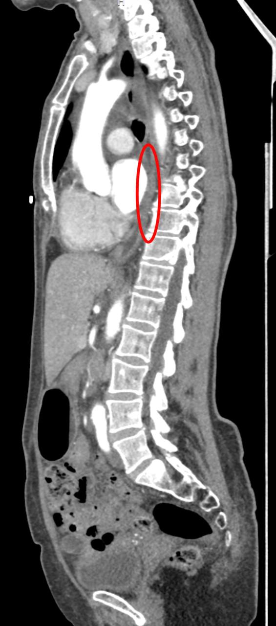В Клинику факультетской хирургии им. Н.Н. Бурденко Сеченовского Университета поступила пациентка с диагнозом рак пищевода. Диагноз был поставлен женщине по месту жительства. При углубленном обследовании в клинике Сеченовского университета врачи обнаружили у женщины второе онкологическое заболевание — опухоль в восходящем отделе ободочной кишки. Перед врачами стояла сложная задача — удалить два злокачественных новообразования, расположенных в разных анатомических зонах, в рамках одной операции. Как рассказали «Медицинской России» в Клинике, вмешательство состояло из трёх этапов.