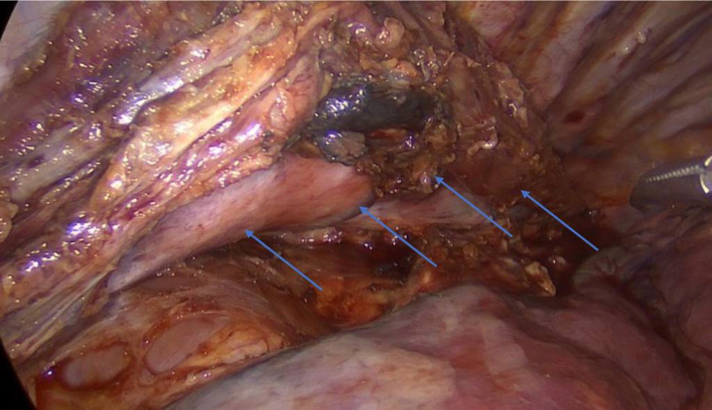 В Клинику факультетской хирургии им. Н.Н. Бурденко Сеченовского Университета поступила пациентка с диагнозом рак пищевода. Диагноз был поставлен женщине по месту жительства. При углубленном обследовании в клинике Сеченовского университета врачи обнаружили у женщины второе онкологическое заболевание — опухоль в восходящем отделе ободочной кишки. Перед врачами стояла сложная задача — удалить два злокачественных новообразования, расположенных в разных анатомических зонах, в рамках одной операции. Как рассказали «Медицинской России» в Клинике, вмешательство состояло из трёх этапов.