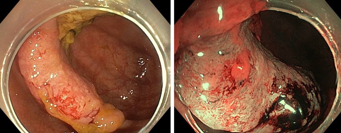 Московские врачи прооперировали пациентку с двумя онкозаболеваниями, удалив обе опухоли за одну операцию
