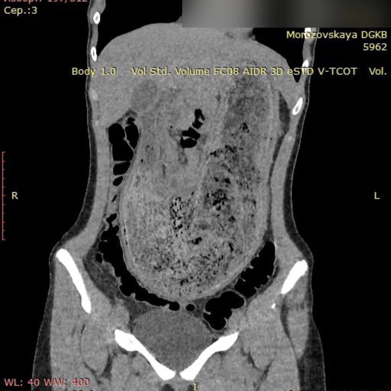 Московские врачи извлекли из желудка пациентки огромный волосяной ком