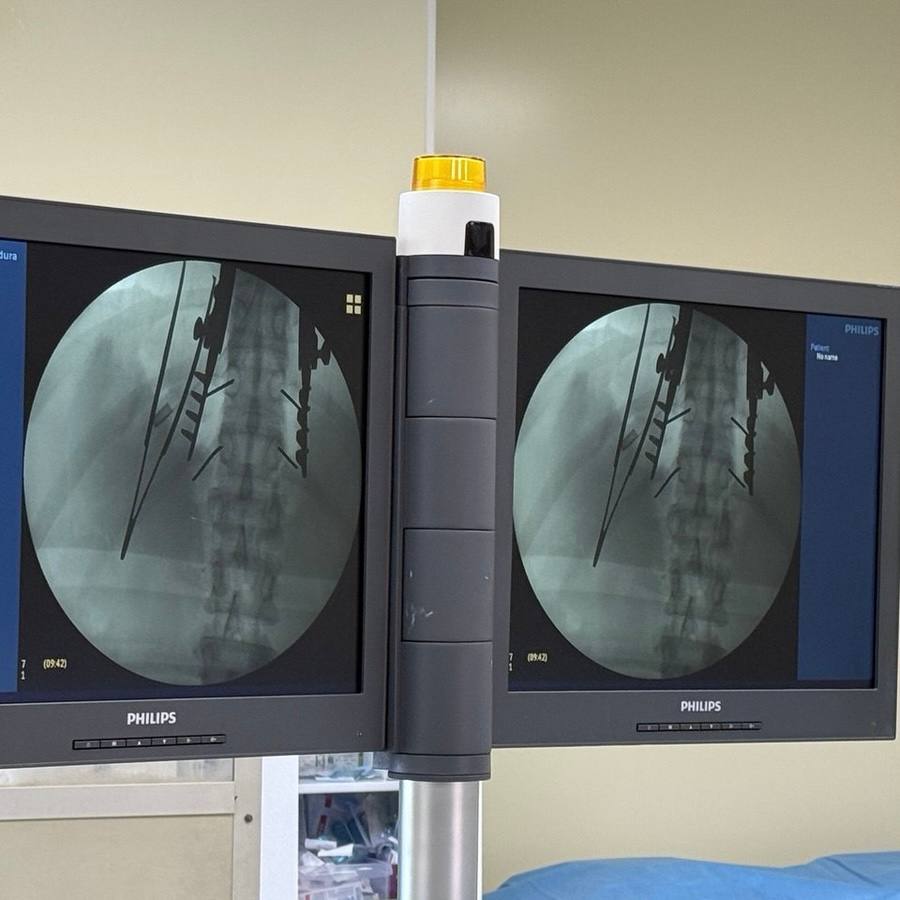 В КГАУЗ «Владивостокская клиническая больница № 2» экстренно доставили 18-летнюю пациентку с тяжёлой травмой позвоночника, полученной во время катания на лыжах. Сначала её транспортировали вертолётом санавиации, а затем на машине скорой помощи. Однако по пути в стационар на трассе водитель грузовика не уступил дорогу «скорой» с включёнными спецсигналами и резко затормозил. Реанимобилю пришлось экстренно снижать скорость, что вызвало у пациентки болевой синдром из-за динамической перегрузки. Медики были вынуждены остановиться на трассе, чтобы стабилизировать её состояние.