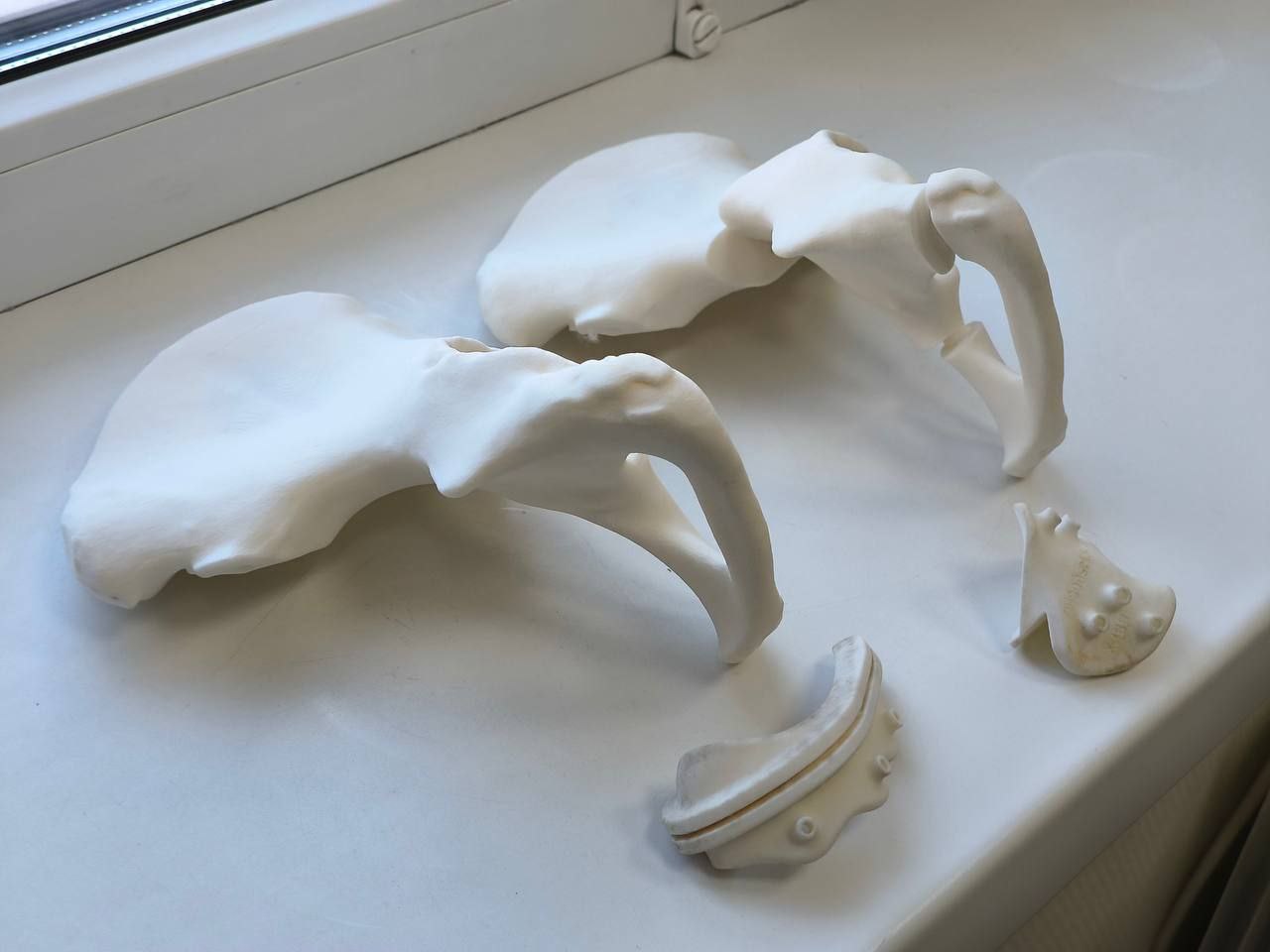 В ФГБУ «Новосибирский НИИТО им. Я. Л. Цивьяна» на протяжении многих лет наблюдалась пациентка с врождённым диспластическим подвывихом левого бедра. Диагноз был поставлен ей практически с рождения. В возрасте 3 месяцев по месту жительства девочке проводилось консервативное лечение по методике «Overhead». Это дозированное вытяжение с последующим закрытым вправлением вывиха. С двух лет — хирургические вмешательства, направленные на устранение подвывиха, в том числе с установкой специальных пластин. Однако из-за особенностей анатомии недоразвитой вертлужной впадины оптимально исправить ситуацию не удавалось.