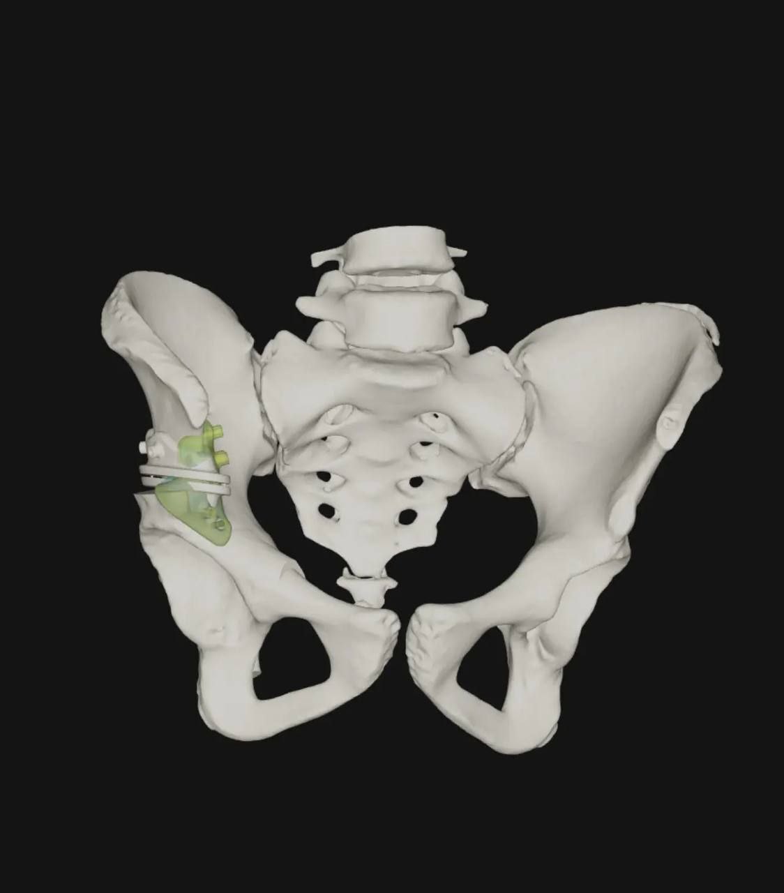 В ФГБУ «Новосибирский НИИТО им. Я. Л. Цивьяна» на протяжении многих лет наблюдалась пациентка с врождённым диспластическим подвывихом левого бедра. Диагноз был поставлен ей практически с рождения. В возрасте 3 месяцев по месту жительства девочке проводилось консервативное лечение по методике «Overhead». Это дозированное вытяжение с последующим закрытым вправлением вывиха. С двух лет — хирургические вмешательства, направленные на устранение подвывиха, в том числе с установкой специальных пластин. Однако из-за особенностей анатомии недоразвитой вертлужной впадины оптимально исправить ситуацию не удавалось.