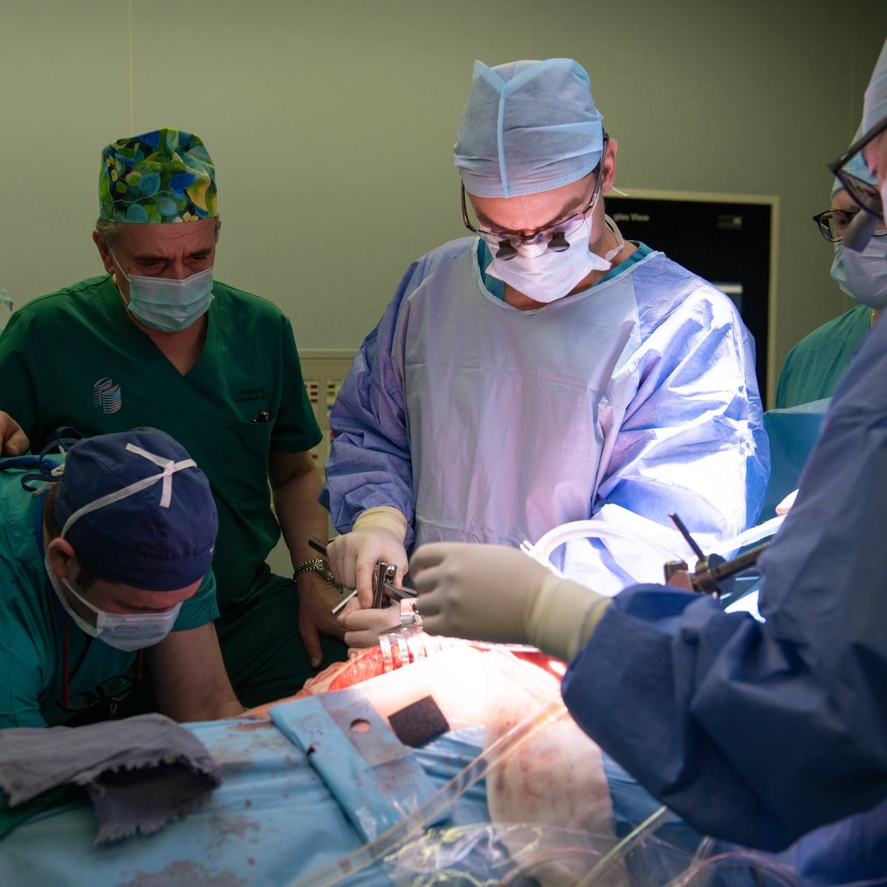 В ФГБУ «НМИЦ Онкологии им. Н.Н. Блохина» поступил мужчина с крайне редкой и агрессивной опухолью сердца — саркомой. Такое новообразование встречается с частотой 1 на 50 тысяч. Несколько клиник отказали пациенту в лечении, считая случай безнадёжным. До опухоли было сложно добраться, а полностью удалить — почти невозможно. Новообразование стремительно росло, практически перекрыло кровоток в сердце, опустилось по нижней полой вене и достигло печени, сформировав опухолевый тромб длиной 10 см.