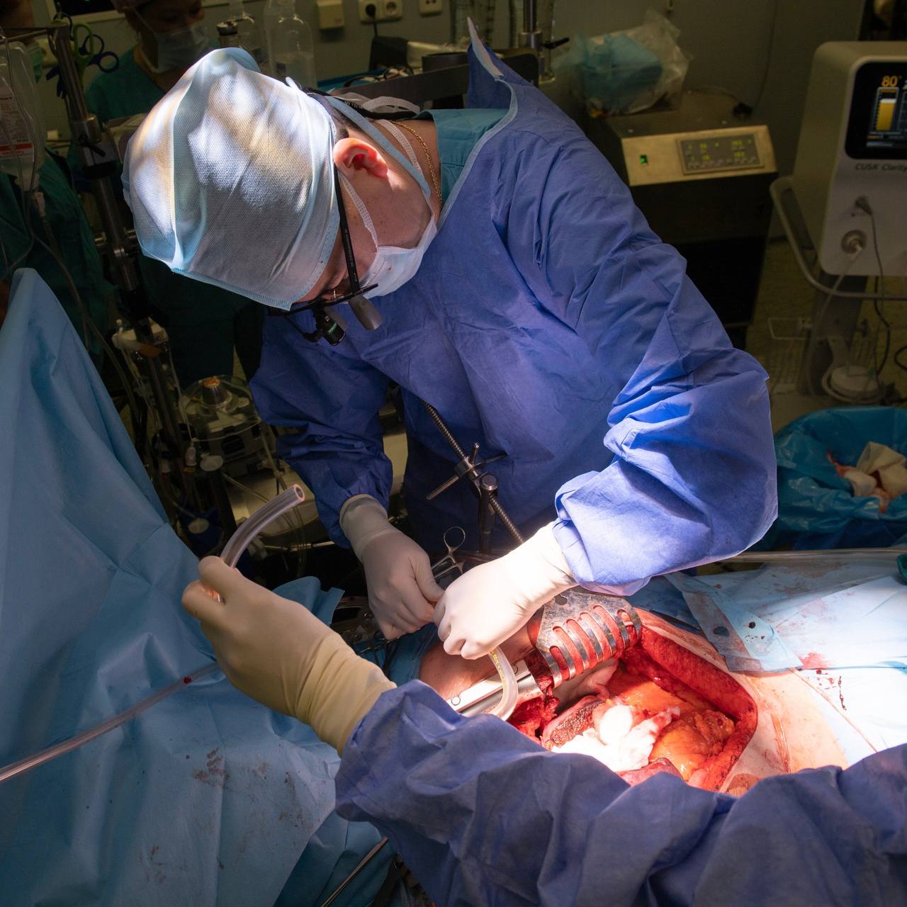 Московские врачи прооперировали пациента с редкой опухолью сердца, достигшей печени