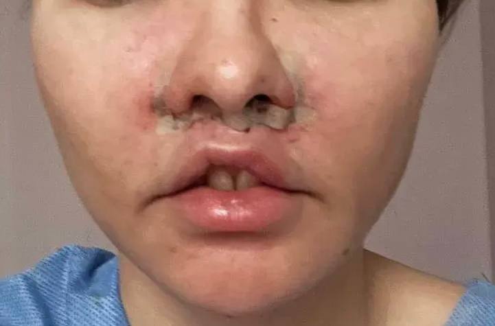 Пациентка отсудила у клиники 1,5 млн рублей за неудачную пластику губ
