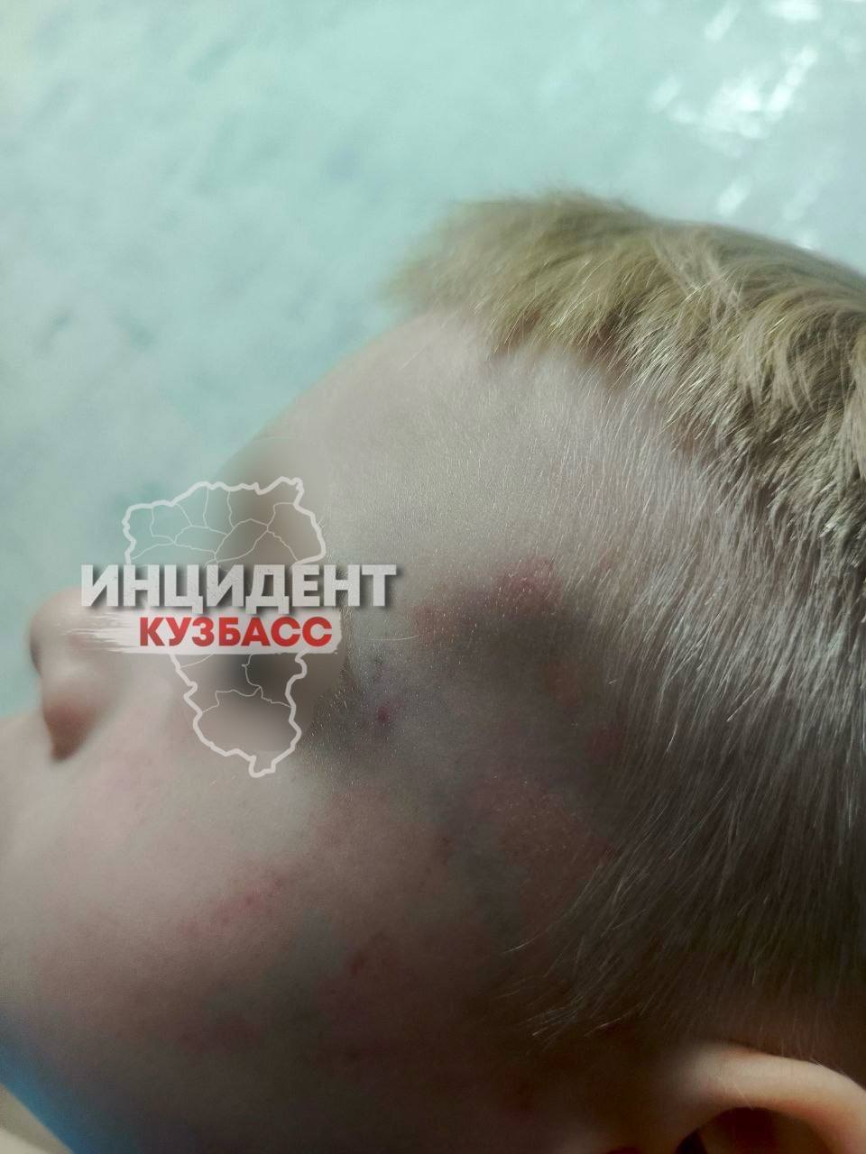 Следственный комитет возбудил уголовное дело по статье «Халатность» в отношении должностных лиц ГБУЗ «Кемеровский детский клинический психоневрологический санаторий “Искорка”» после того, как мать четырёхлетнего пациента заявила о причинённых её сыну травмах. По словам женщины, инцидент произошел 14 января. На фотографиях видны синяки и ссадины на руках, шее и голове ребёнка. Мать утверждает, что их с сыном направляли лишь на две судебно-медицинские экспертизы, результаты которых она до сих пор не получила.