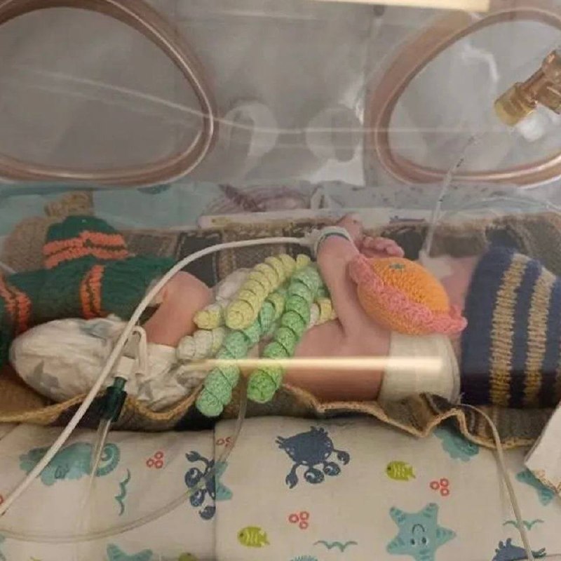 Московские врачи прооперировали недоношенного младенца весом два килограмма с коарктацией аорты