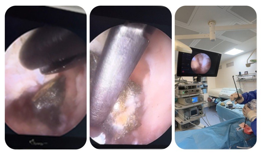 Московские врачи провели уникальную операцию по удалению металлического осколка из позвоночника