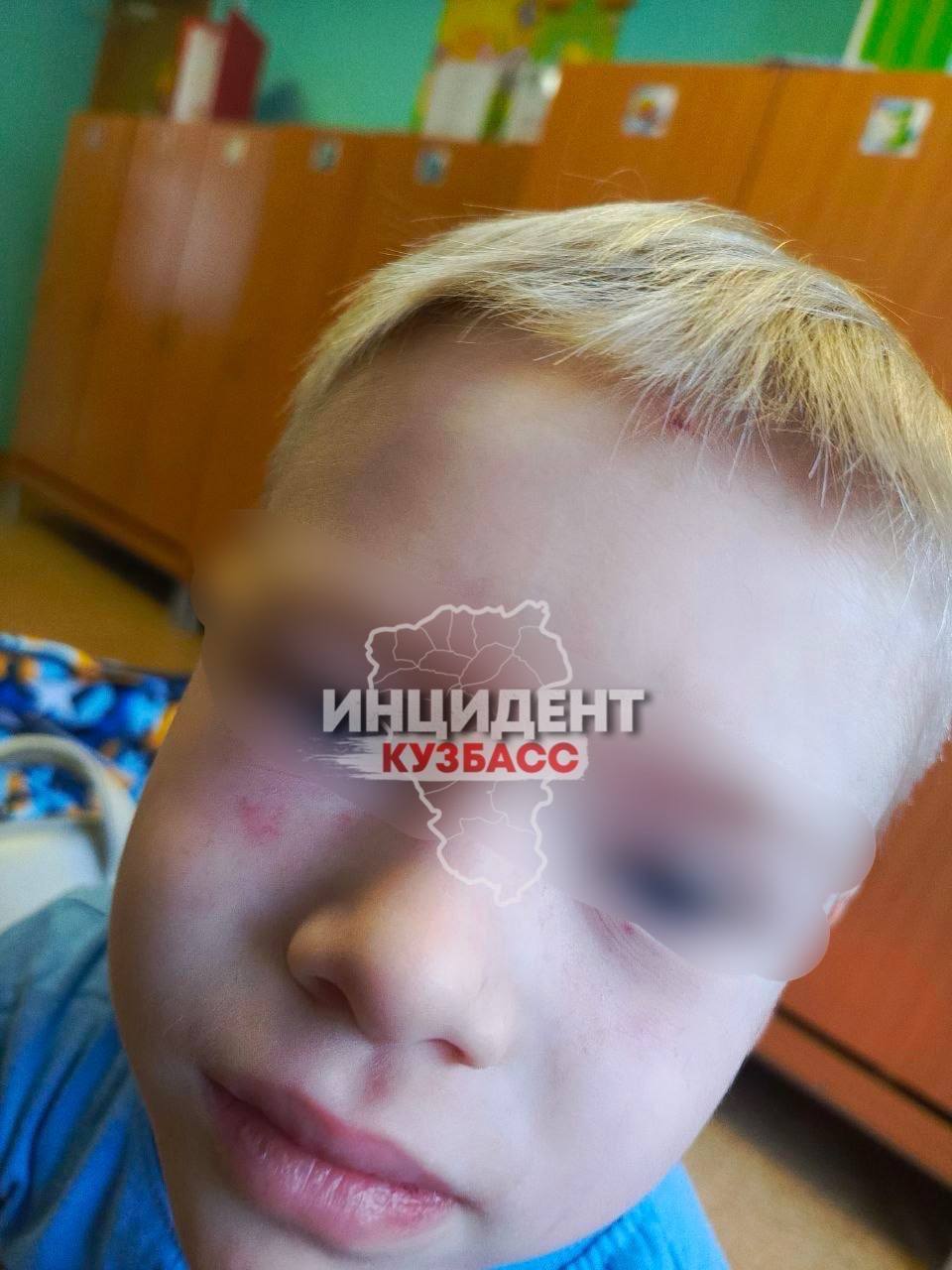 Следственный комитет возбудил уголовное дело по статье «Халатность» в отношении должностных лиц ГБУЗ «Кемеровский детский клинический психоневрологический санаторий “Искорка”» после того, как мать четырёхлетнего пациента заявила о причинённых её сыну травмах. По словам женщины, инцидент произошел 14 января. На фотографиях видны синяки и ссадины на руках, шее и голове ребёнка. Мать утверждает, что их с сыном направляли лишь на две судебно-медицинские экспертизы, результаты которых она до сих пор не получила.