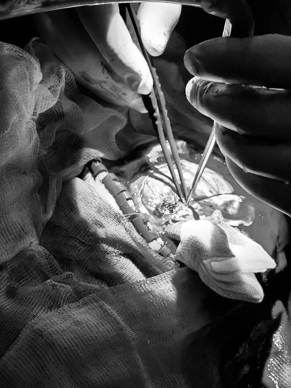 41-летняя женщина поступила в БСМП 2 марта с массивным кровоизлиянием, причиной которого стала аневризма. «Необходимо было действовать быстро, так как состояние женщины ухудшалось из-за очень высокого артериального давления – верхние цифры на тонометре приближались к отметке “300”. Была собрана мультидисциплинарная бригада больницы: нейрохирурги, реаниматологи, рентгенэндоваскулярные хирурги», – рассказал главный внештатный реаниматолог Набережных Челнов Василь Фазылов.