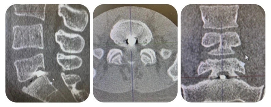 В ФГБУ «Главный военный клинический госпиталь им. ак. Н.Н. Бурденко» Министерства обороны РФ поступил пациент с осколочным ранением пояснично-крестцового отдела позвоночника. Травму он получил при взрыве снаряда. В течение двух месяцев мужчине проводилось консервативное лечение, однако сохранялись болевой синдром и парестезии в проекции S1 корешка. При повторном обследовании был обнаружен металлический осколок в межтеловом промежутке по срединной линии на уровне L5 и S1 позвонков. Инородное тело прошло между дужками сзади по краю фасеточного сустава.
