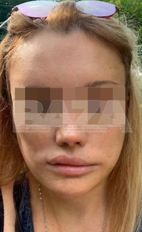 Частная клиника выплатила пациентке 2,3 миллиона за повреждение лицевых нервов во время пластической операции