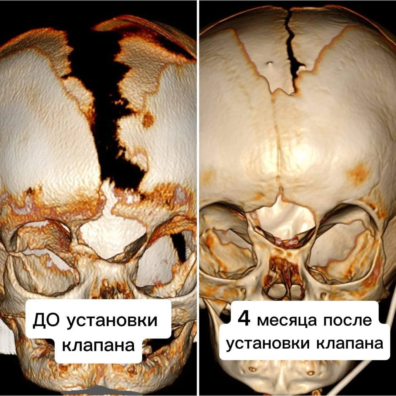 В ГБУЗ «Научно-исследовательский институт неотложной детской хирургии и травматологии (Клиника доктора Рошаля)» Москвы в двухмесячном возрасте поступил мальчик с редкой и тяжёлой патологией. Ребёнок родился в двойне. Сестра пациента была полностью здорова, а у мальчика диагностировали носолобное менингоэнцефалоцеле и порэнцефалитическую кисту левого полушария головного мозга.