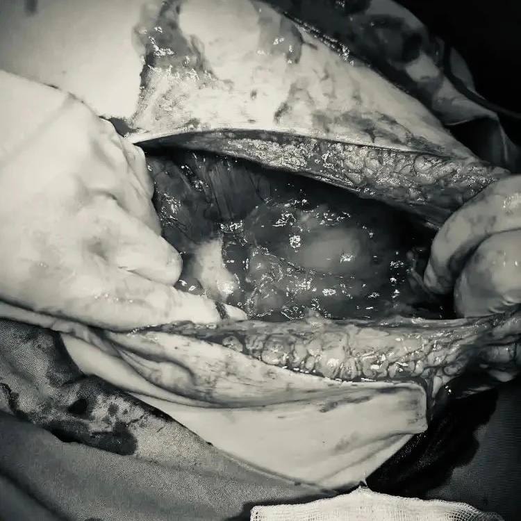 В ГАУЗ «Республиканский клинический онкологический диспансер МЗ РТ имени профессора М. З. Сигала» поступила женщина с жалобами на резкое увеличение живота. За два с небольшим месяца живот вырос настолько, что окружающие принимали пациентку за беременную на позднем сроке. Причиной была опухоль яичника, которая выросла до 30 сантиметров. Дополнительно в брюшной полости скопилось около полутора литров жидкости.