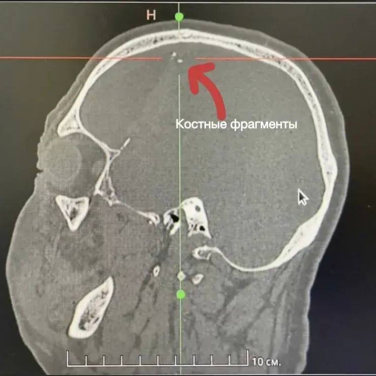 Врачи Владивостокской клинической больницы № 2 провели экстренную операцию пациенту с тяжелой открытой черепно-мозговой травмой после падения на металлический арматурный стержень.