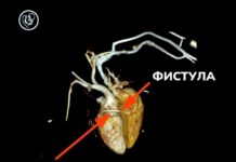Врачи проводят лечение новорождённого с врождённым пороком сердца
