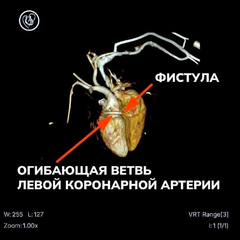 Врачи проводят лечение новорождённого с врождённым пороком сердца